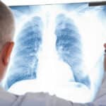 Doctor looking at pneumonia on x-ray